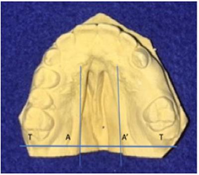 Maternal Smoking Leads to Larger Cleft Palate Defects